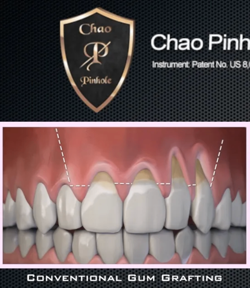 Chao Pinhole® tehnika: Lečenje povlačenja desni bez hirurgije